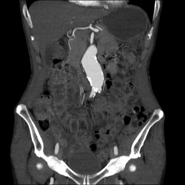 File:Abdominal aortic aneurysm (Radiopaedia 23703-23856 Coronal C+ arterial phase 8).jpg
