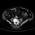 Abdominal aortic aneurysm (Radiopaedia 25855-26001 Axial C+ arterial phase 88).jpg