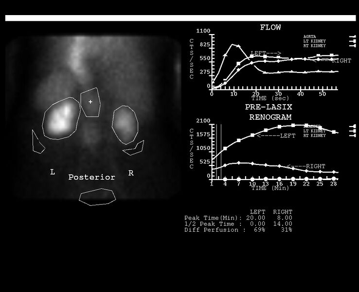 File:Abdominal aortic aneurysm (incidental finding on renal scintigraphy) (Radiopaedia 23997-24195 None 3).jpg