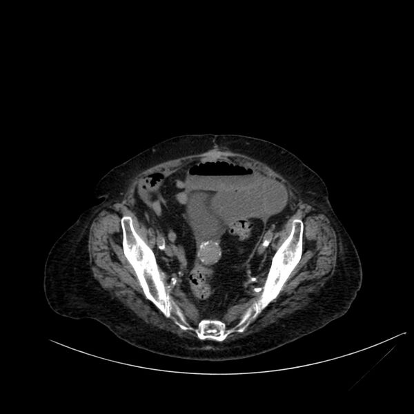 File:Abdominal aortic aneurysm - impending rupture (Radiopaedia 19233-19246 Axial non-contrast 103).jpg
