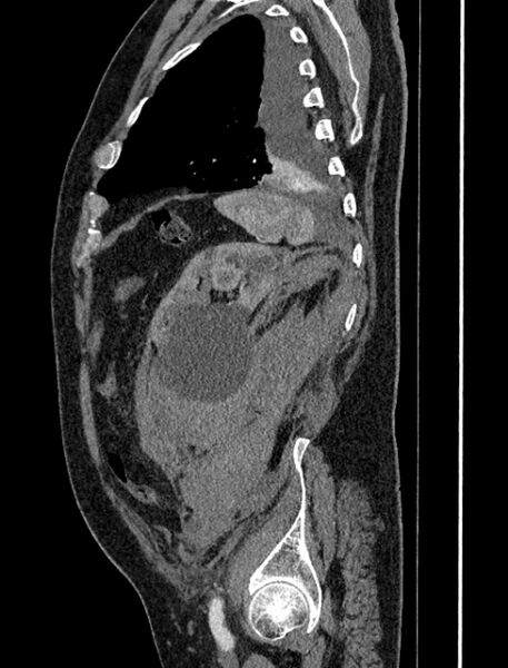 File:Abdominal aortic aneurysm rupture (Radiopaedia 54179-60362 Sagittal C+ arterial phase 36).jpg