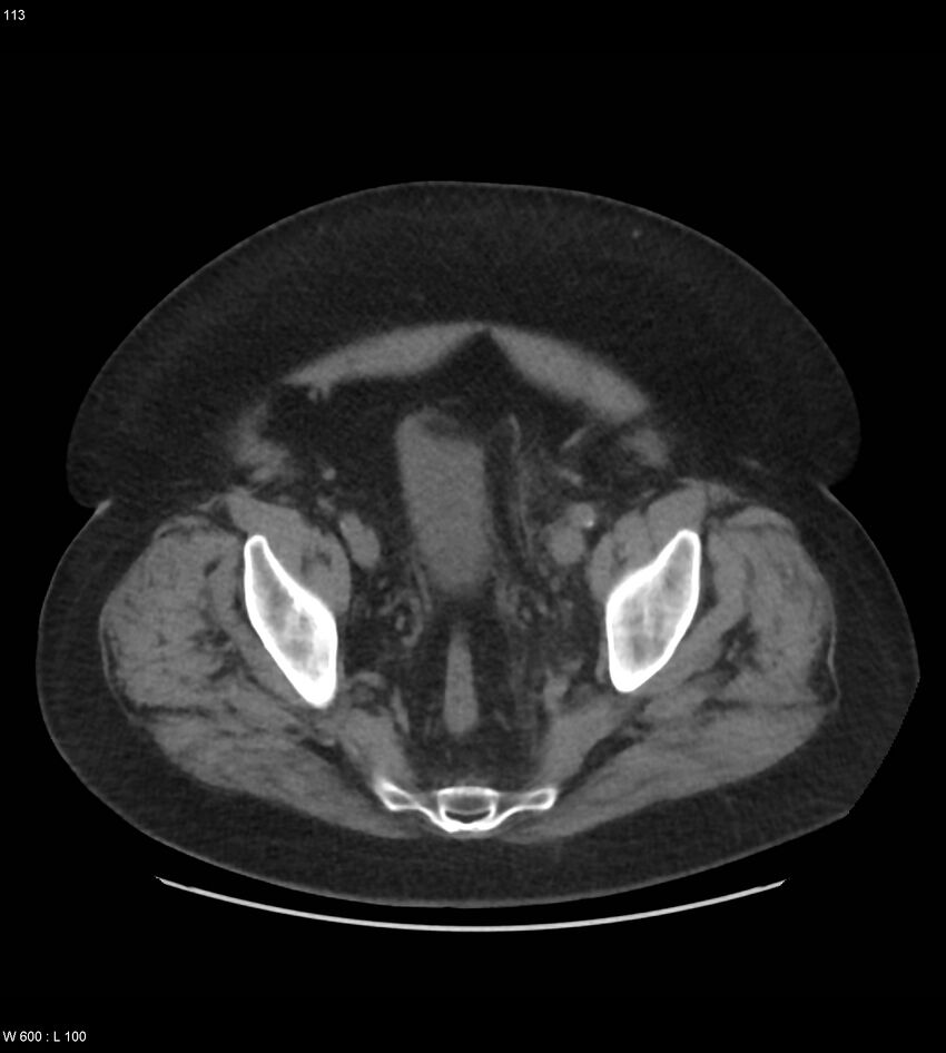 Abdominal aortic aneurysm with intramural hematoma then rupture (Radiopaedia 50278-55631 Axial non-contrast 109).jpg