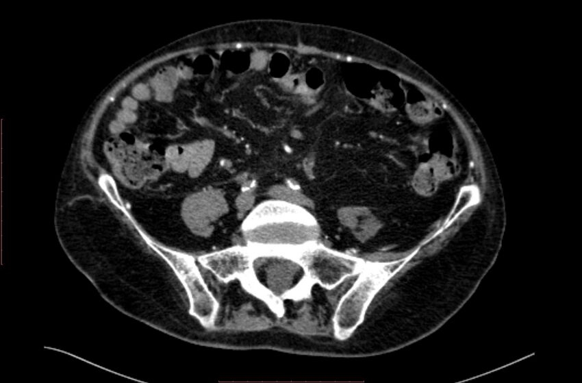 Abdominal aortic interposition tube graft and aneurysm thrombosis (Radiopaedia 71438-81857 Axial C+ arterial phase 139).jpg