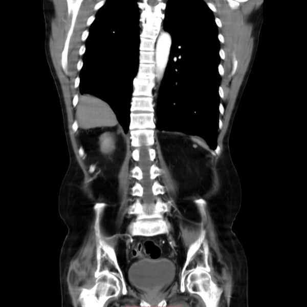 File:Abdominal aortic interposition tube graft and aneurysm thrombosis (Radiopaedia 71438-81857 Coronal C+ arterial phase 20).jpg