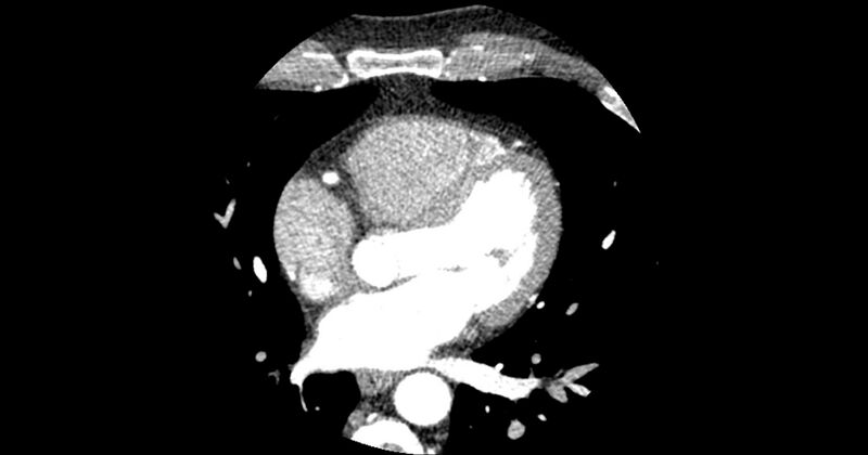 File:Aberrant left main coronary artery (ALMCA) arising from the right sinus with interarterial course (Radiopaedia 63251-71814 Axial C+ arterial phase 92).JPG