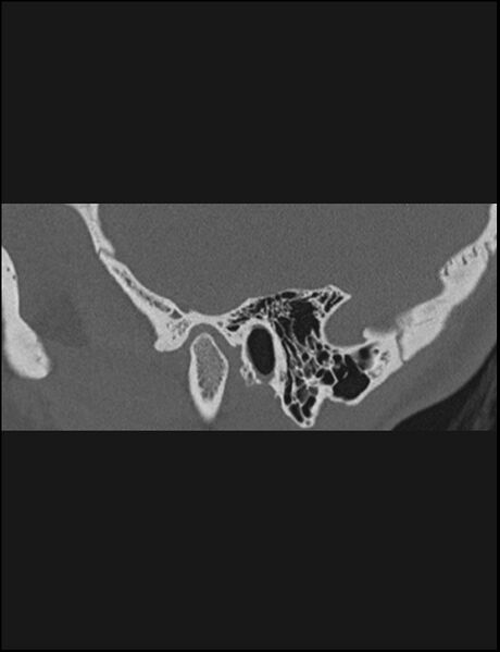 File:Aberrant right internal carotid artery (Radiopaedia 65191-74198 Sagittal non-contrast 30).jpg