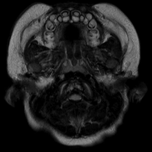 File:Achondroplasia (Radiopaedia 6251-7661 Axial T2 1).jpg