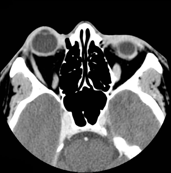 File:Acinic cell carcinoma of the lacrimal gland (Radiopaedia 9480-10160 Axial C+ arterial phase 3).jpg