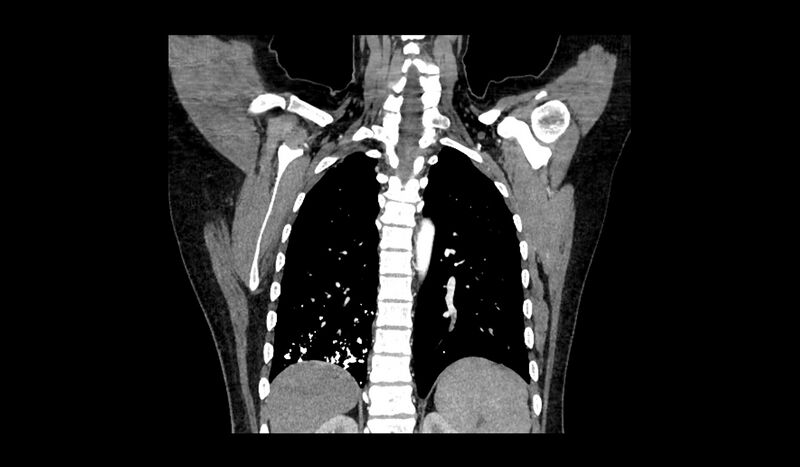 File:Acquired tracheo-esophageal fistula (Radiopaedia 51356-57103 Coronal C+ arterial phase 4).jpg