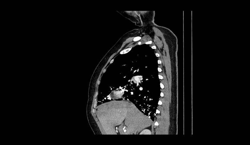 File:Acquired tracheo-esophageal fistula (Radiopaedia 51356-57103 Sagittal C+ arterial phase 11).jpg
