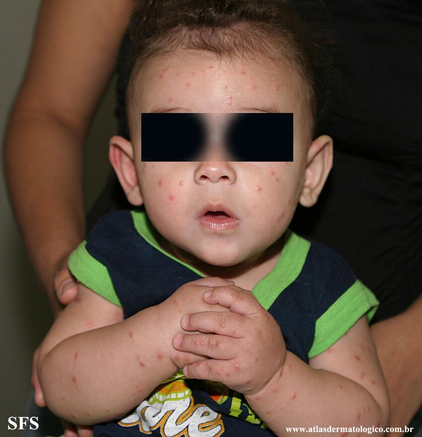 Acrodermatitis Infantile Papular (Dermatology Atlas 35).jpg