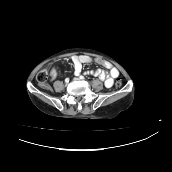 File:Acute-on-chronic Crohn disease with enteroenteric fistula (Radiopaedia 66686-75987 B 30).jpg