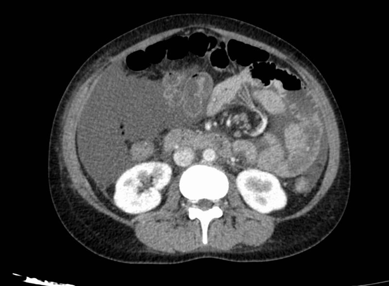 File:Acute Budd-Chiari syndrome (Radiopaedia 60858-68638 Axial C+ portal venous phase 146).jpg