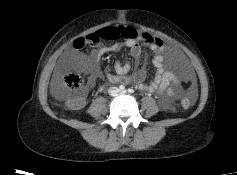 File:Acute Budd-Chiari syndrome (Radiopaedia 60858-68638 Axial C+ portal venous phase 186).jpg