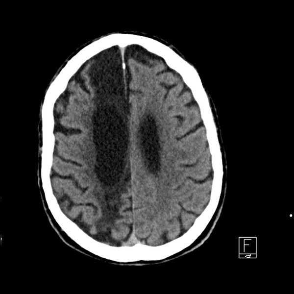 File:Acute ICA ischemic penumbra due to high-grade CCA stenosis (CT perfusion) (Radiopaedia 72038-82529 Axial non-contrast 34).jpg