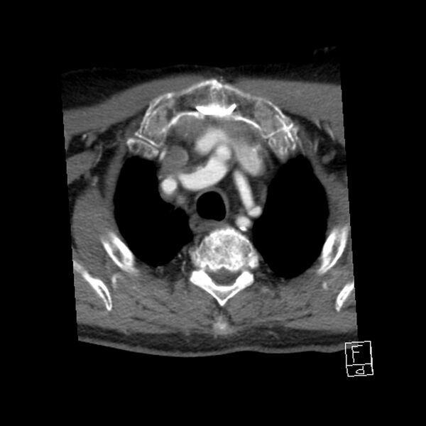 File:Acute ICA ischemic penumbra due to high-grade CCA stenosis (CT perfusion) (Radiopaedia 72038-82530 Axial C+ arterial phase 74).jpg