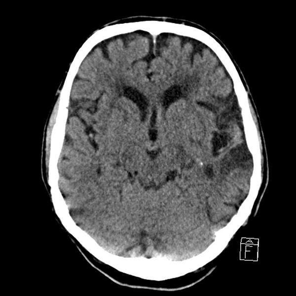 File:Acute P1 occlusion with PCA ischemia penumbra (CT perfusion) (Radiopaedia 72084-82586 Axial non-contrast 17).jpg