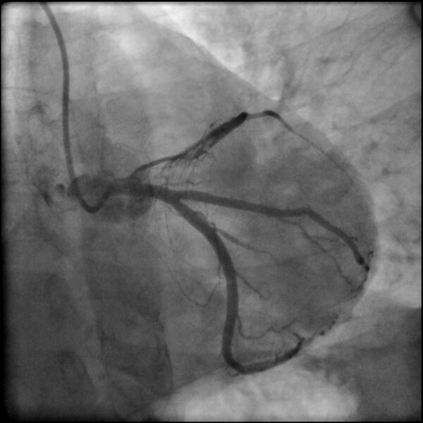 File:Acute anteroseptal myocardial infarction (Radiopaedia 68409-77946 LAO caudal (spider view) LAD and CX 33).jpg