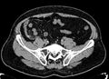 Acute appendicitis (Radiopaedia 13030-13091 Axial non-contrast 32).jpg