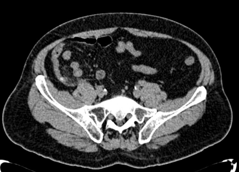 File:Acute appendicitis (Radiopaedia 13030-13091 Axial non-contrast 32).jpg