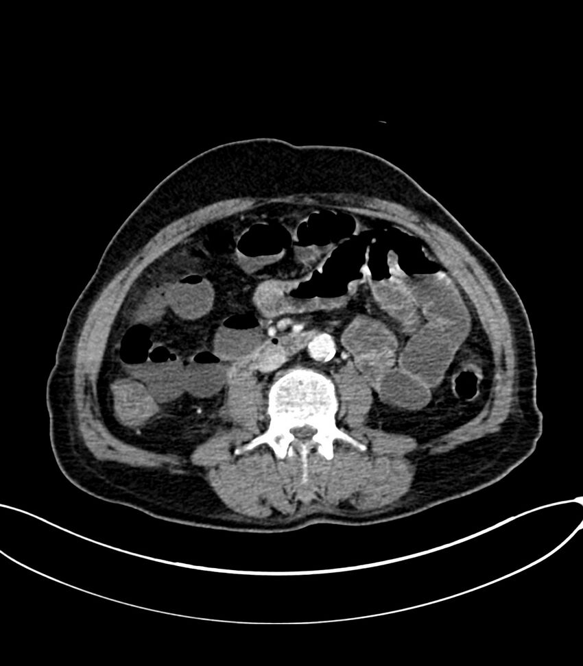 Acute arterial mesenteric ischemia (Radiopaedia 78238-90828 Axial C+ portal venous phase 70).jpg