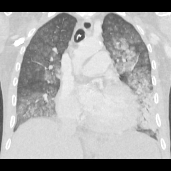 File:Acute diffuse alveolar hemorrhage (Radiopaedia 41323-44158 Coronal lung window 22).jpg