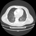 Acute heart failure (CT) (Radiopaedia 79835-93075 Axial lung window 28).png
