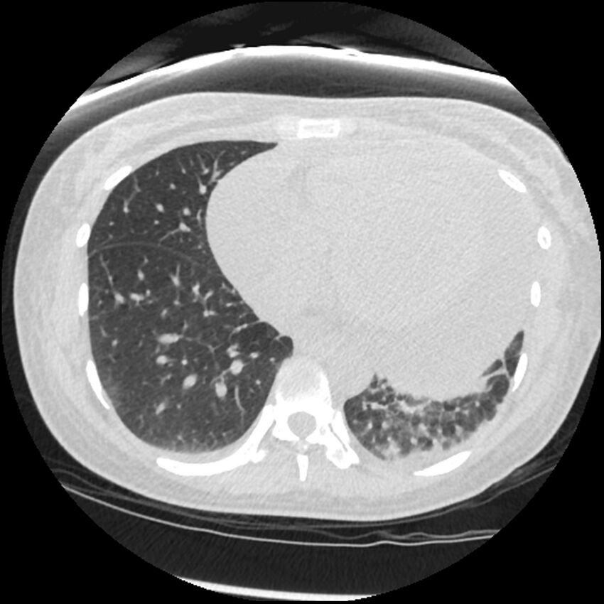 Acute lupus nephritis (Radiopaedia 45832-50107 Axial lung window 66).jpg
