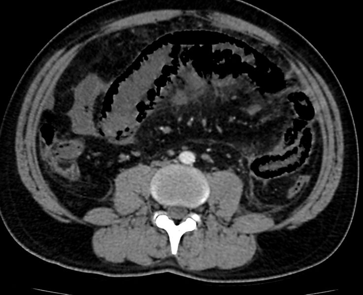 File:Acute mesenteric ischemia - superior mesenteric artery thrombosis (Radiopaedia 73947-84776 Axial C+ arterial phase 81).jpg