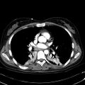 Acute myocardial infarction in CT (Radiopaedia 39947-42415 Axial C+ arterial phase 71).jpg