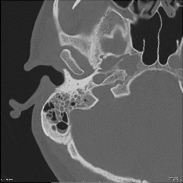 File:Acute otomastoiditis (Radiopaedia 28276-28512 Axial PTB bone window reformat 53).jpg