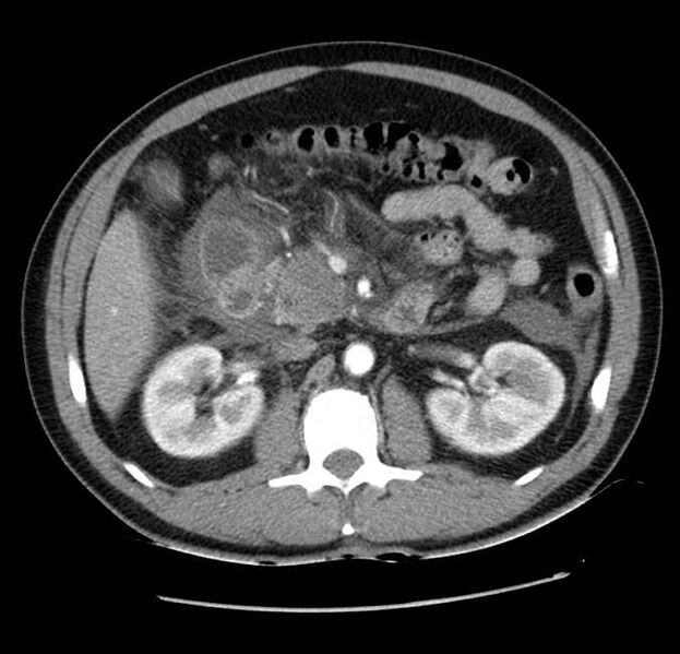 File:Acute pancreatitis - Balthazar E (Radiopaedia 23080-23110 Axial C+ arterial phase 28).jpg