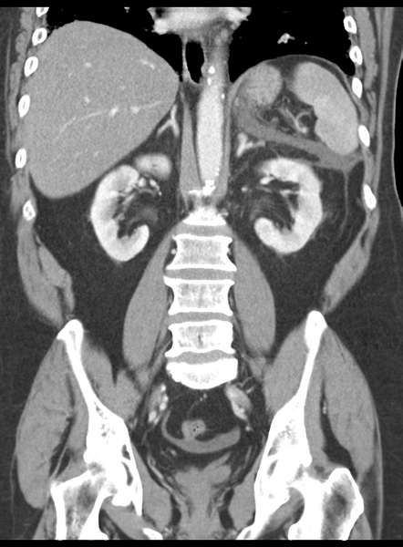File:Acute pancreatitis complicated by portal vein thrombus (Radiopaedia 48148-52990 Coronal C+ portal venous phase 41).png