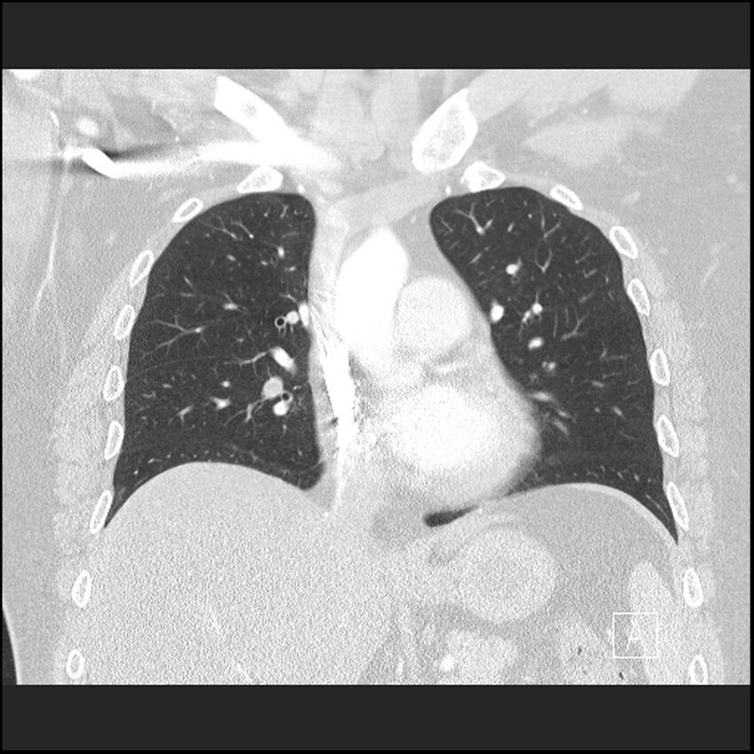 Acute pulmonary embolism with pulmonary infarct (Radiopaedia 73062-83768 Coronal lung window 34).jpg