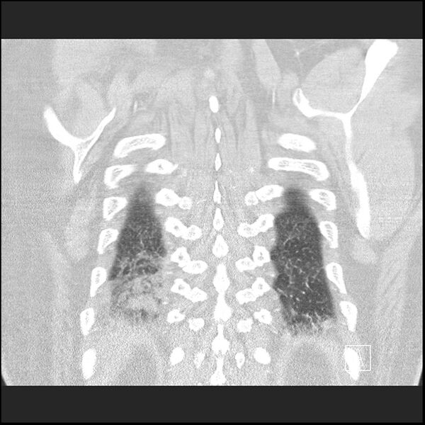 File:Acute pulmonary embolism with pulmonary infarct (Radiopaedia 73062-83768 Coronal lung window 68).jpg