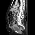 Acute pyelonephritis (Radiopaedia 25657-25837 Sagittal renal parenchymal phase 41).jpg