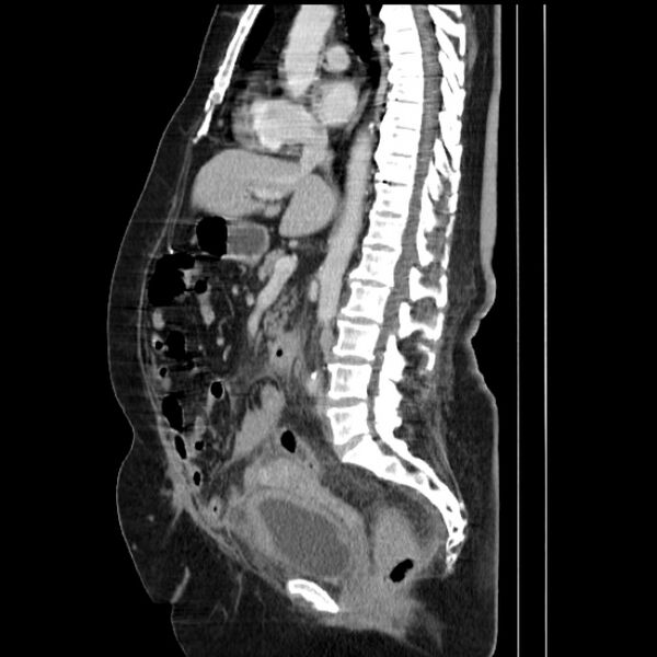 File:Acute pyelonephritis (Radiopaedia 25657-25837 Sagittal renal parenchymal phase 41).jpg