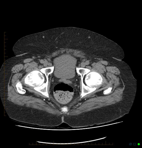 File:Acute renal failure post IV contrast injection- CT findings (Radiopaedia 47815-52557 Axial non-contrast 77).jpg