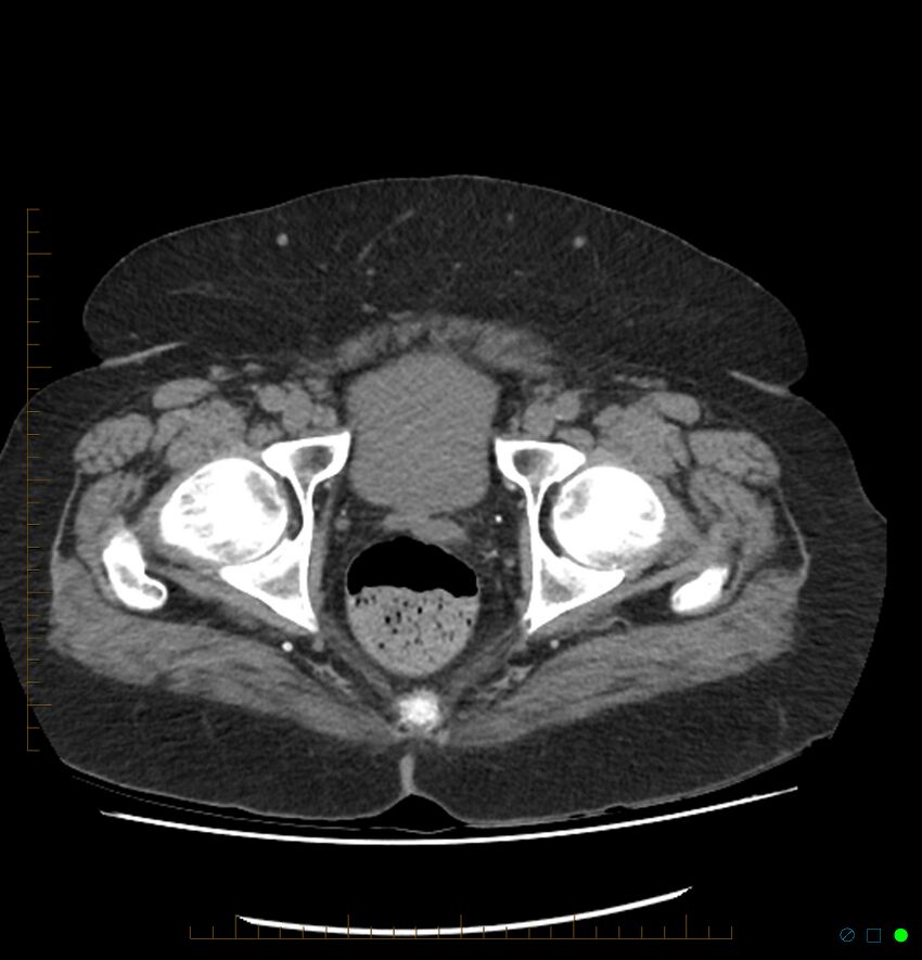 Acute renal failure post IV contrast injection- CT findings (Radiopaedia 47815-52557 Axial non-contrast 77).jpg