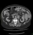 Acute renal failure post IV contrast injection- CT findings (Radiopaedia 47815-52559 Axial C+ portal venous phase 35).jpg