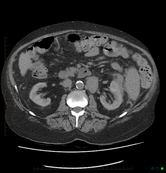 File:Acute renal failure post IV contrast injection- CT findings (Radiopaedia 47815-52559 Axial C+ portal venous phase 35).jpg
