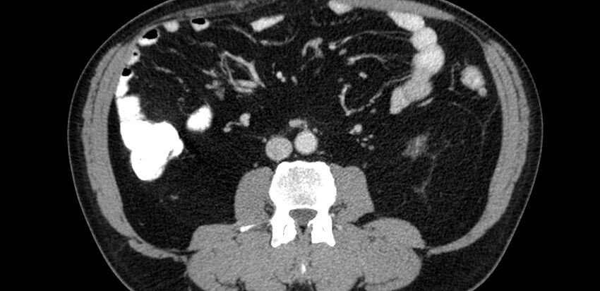 Acute sigmoid colon diverticulitis (Radiopaedia 55507-61976 Axial C+ portal venous phase 21).jpg