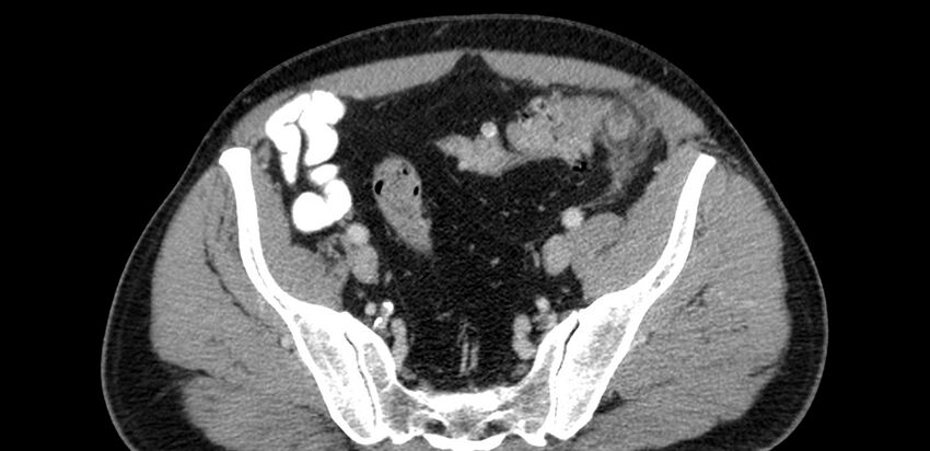 Acute sigmoid colon diverticulitis (Radiopaedia 55507-61976 Axial C+ portal venous phase 84).jpg