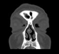 Acute sinusitis (Radiopaedia 23161-23215 Coronal bone window 21).jpg