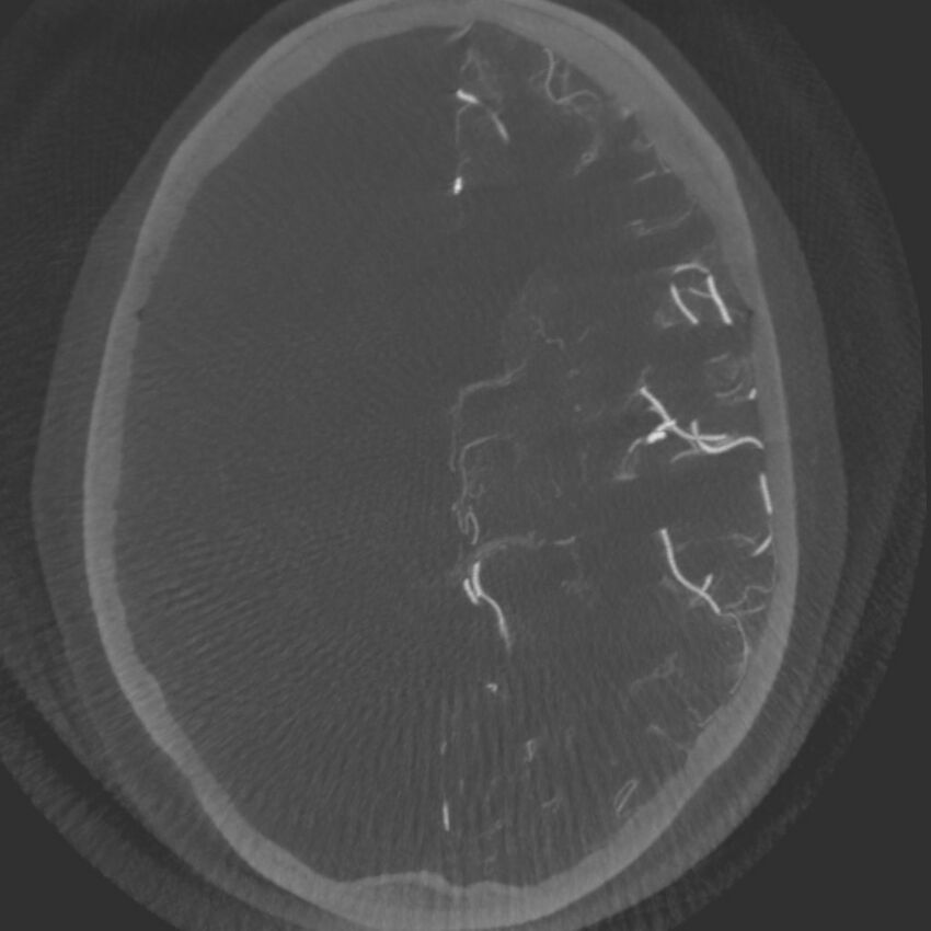 Acute subarachnoid hemorrhage and accessory anterior cerebral artery (Radiopaedia 69231-79010 C 40).jpg