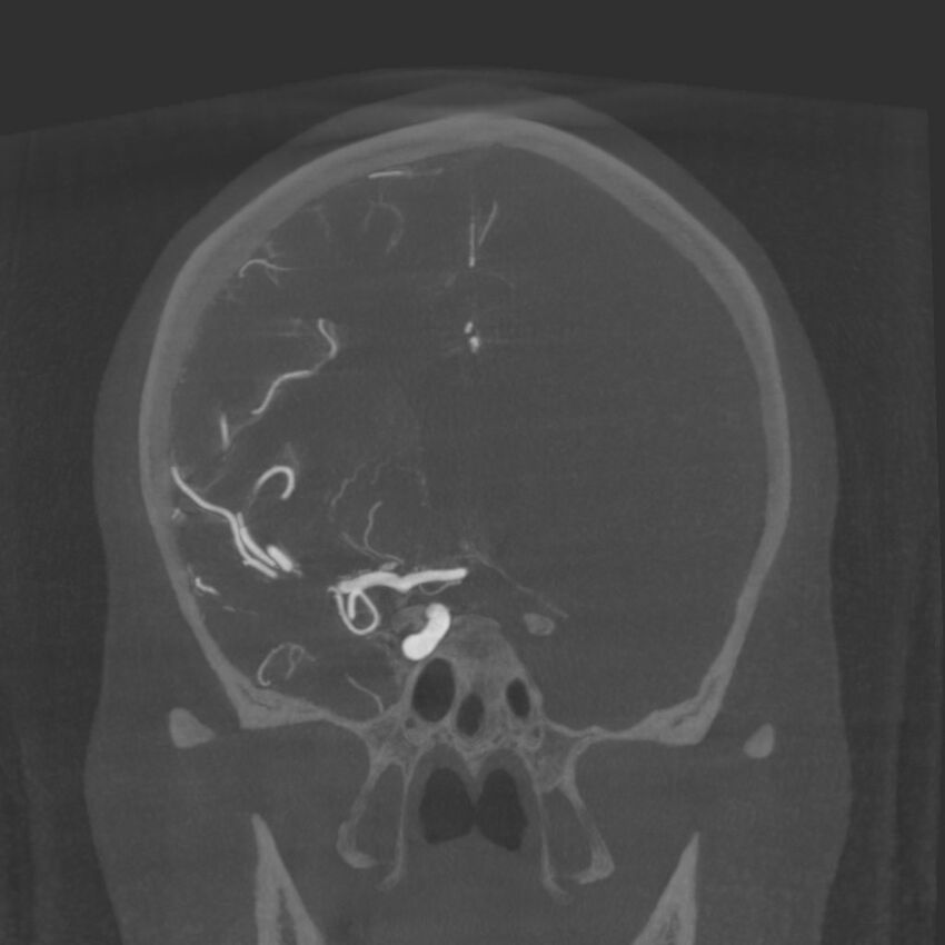 Acute subarachnoid hemorrhage and accessory anterior cerebral artery (Radiopaedia 69231-79010 Coronal arterial - MIP 42).jpg