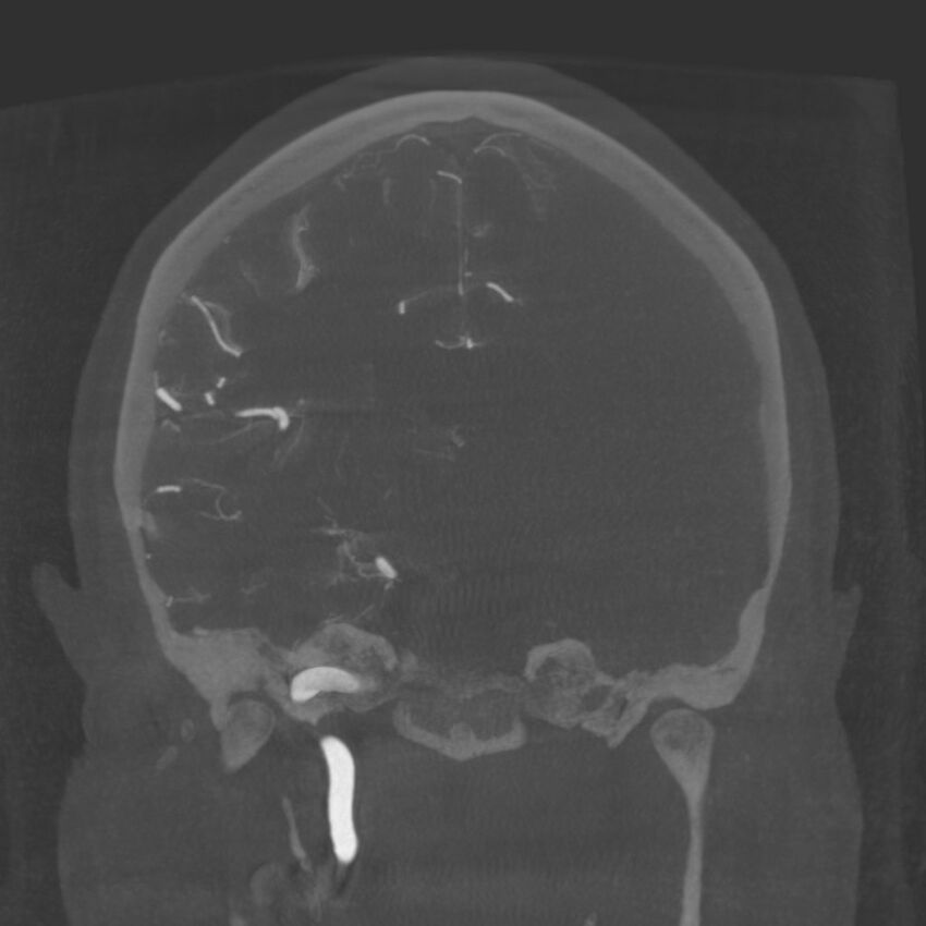 Acute subarachnoid hemorrhage and accessory anterior cerebral artery (Radiopaedia 69231-79010 Coronal arterial - MIP 57).jpg