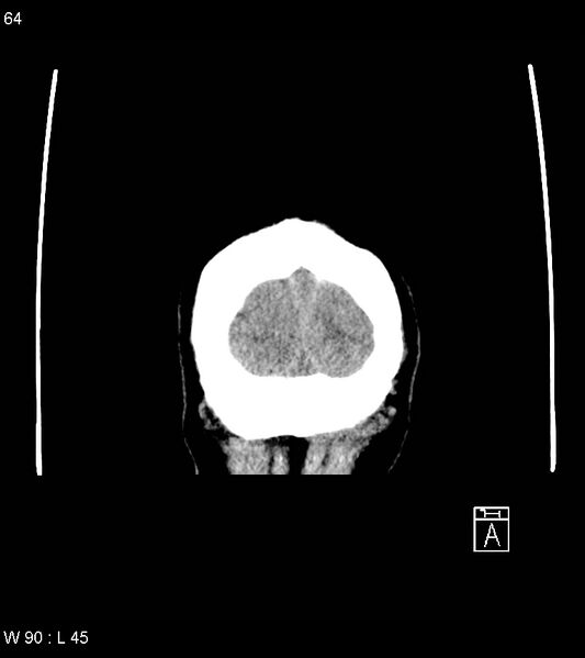 File:Acute subdural hematoma with myelofibrosis (Radiopaedia 52582-58494 Coronal non-contrast 55).jpg