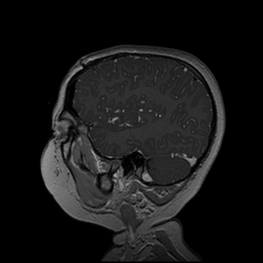 Adamantinomatous craniopharyngioma (Radiopaedia 77407-89529 H 28).jpg