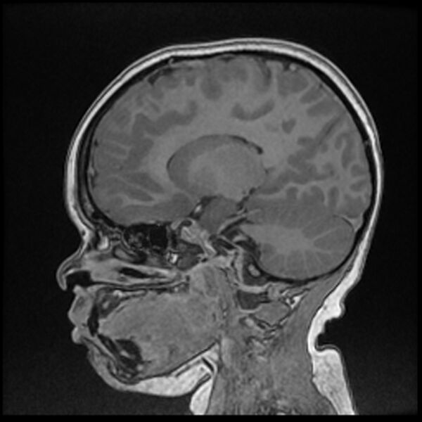 File:Adamantinomatous craniopharyngioma (Radiopaedia 77407-89529 Sagittal T1 C+ 55).jpg
